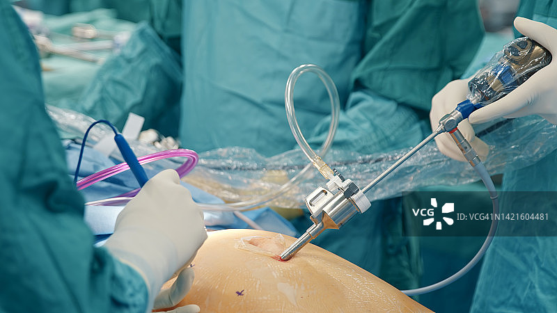 医生和护士团队共同进行腹腔镜手术图片素材