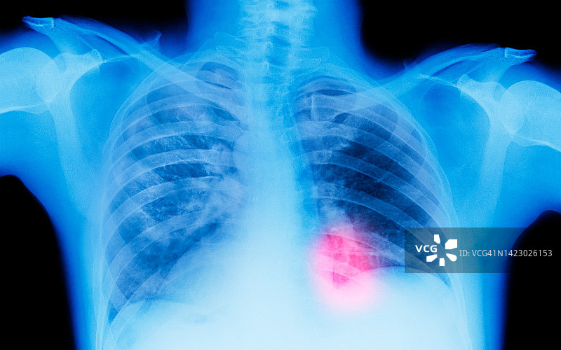 显示乳腺癌的X光片图片素材