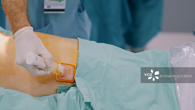 术前腹部碘酒消毒处理特写图片素材