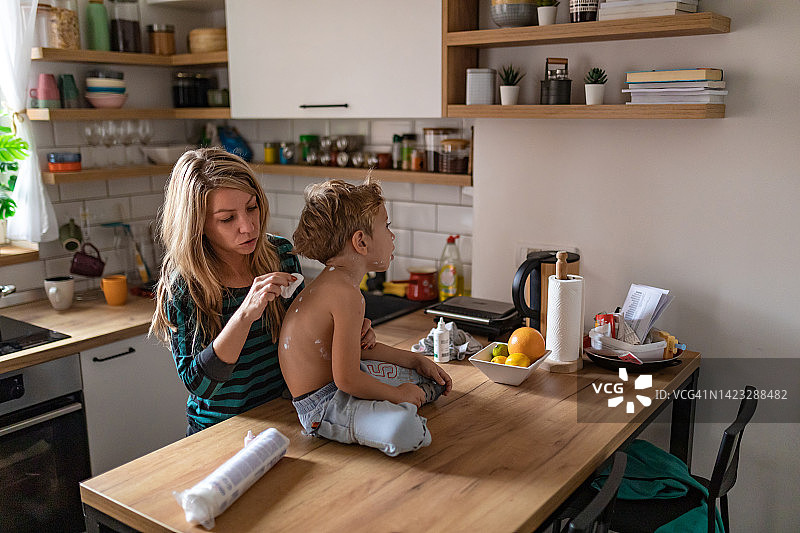 一位母亲用棉垫给四岁的儿子涂抹水痘药图片素材