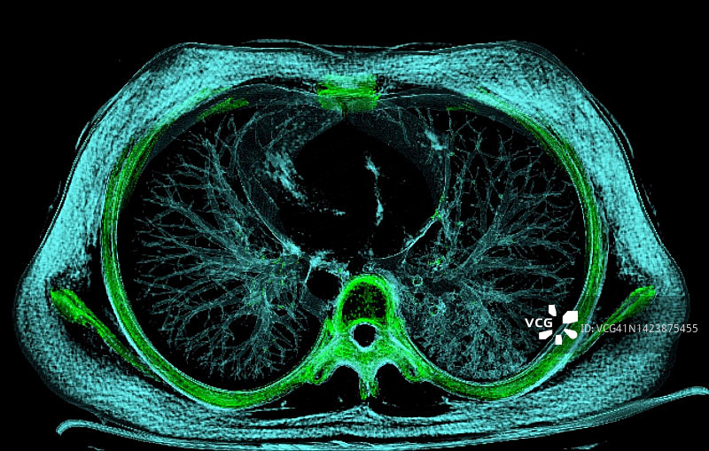 正常肺部CT扫描图片素材