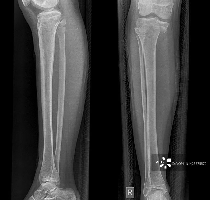 生长板骨折X光片图片素材
