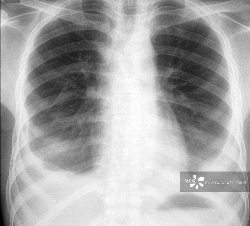 胸腔积液X光片图片素材