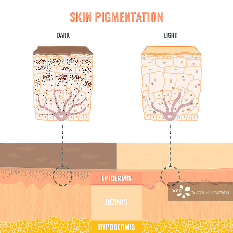 皮肤色素沉淀插图图片素材