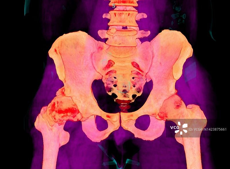 髋关节骨关节炎CT扫描图片素材