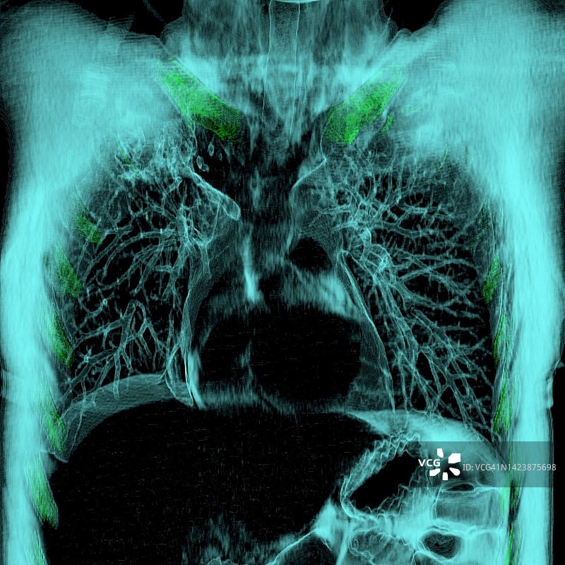 健康的肺和心脏CT扫描图片素材