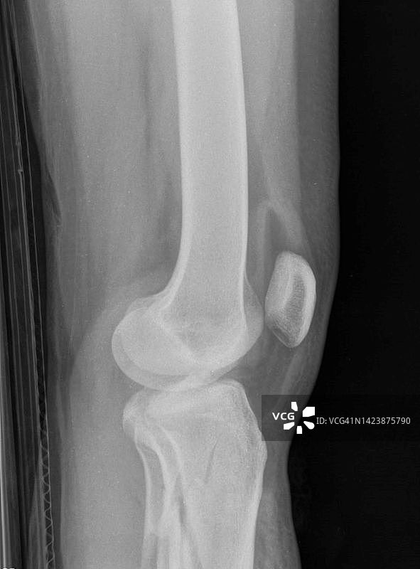 脂肪血关节积血X光片图片素材