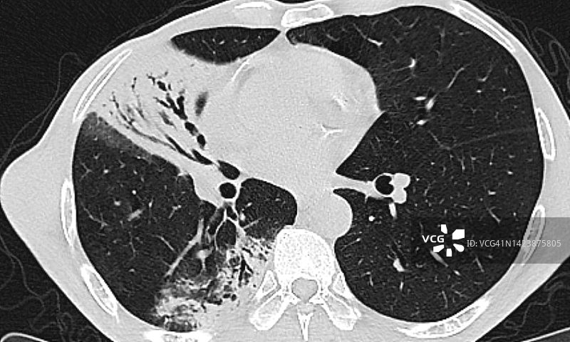支气管充气征X光片图片素材