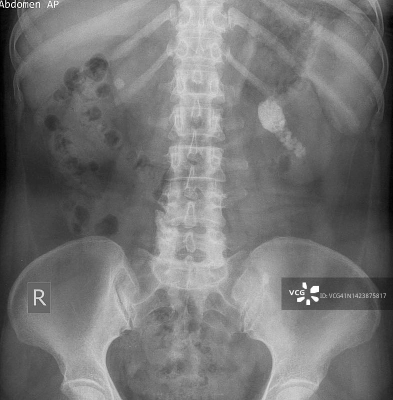 肾结石X光片图片素材