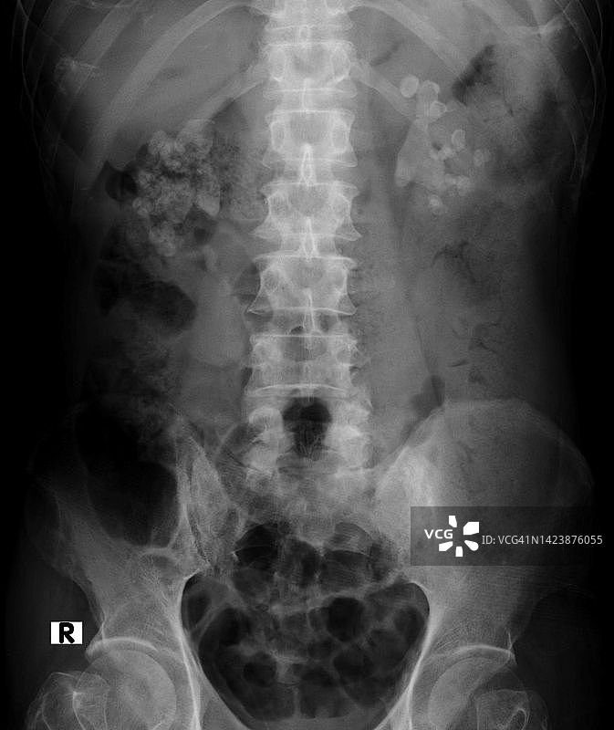 肾结石X光片图片素材
