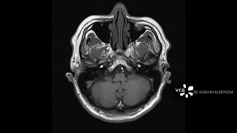 健康的大脑核磁共振扫描图片素材