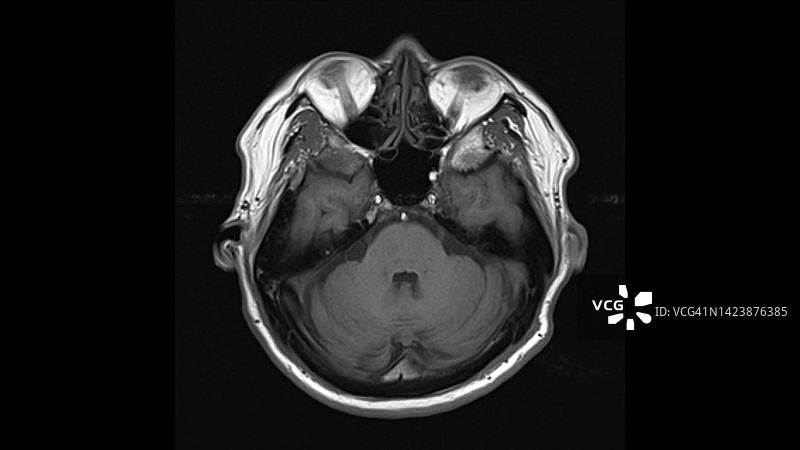 健康的大脑核磁共振扫描图片素材