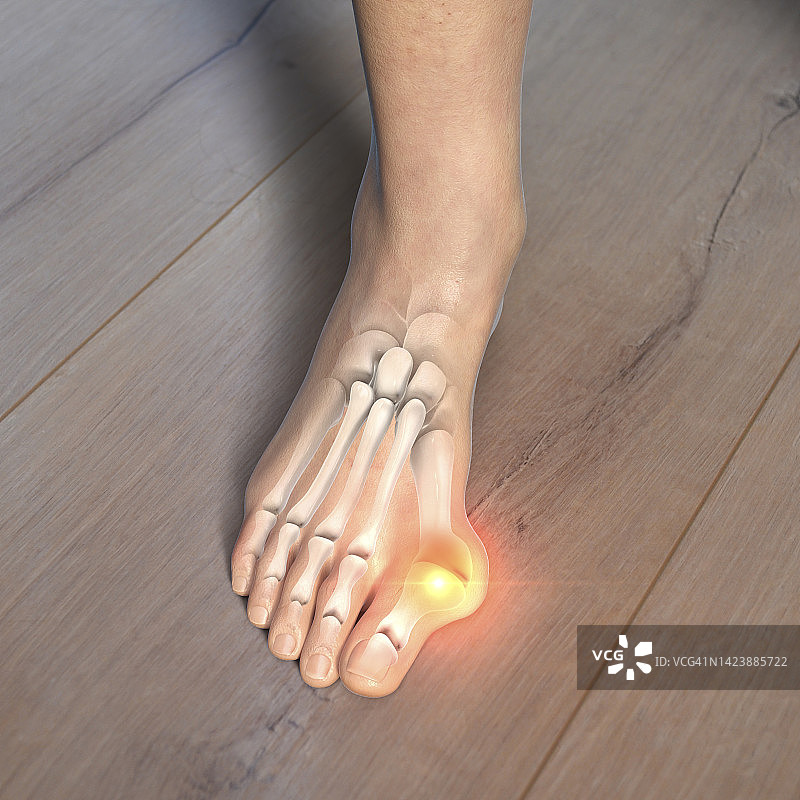 拇囊炎插图图片素材