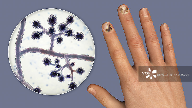 甲癣插图图片素材