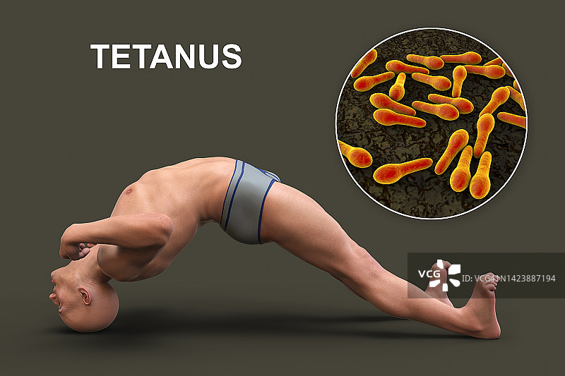 破伤风男子角弓反张症状图示图片素材