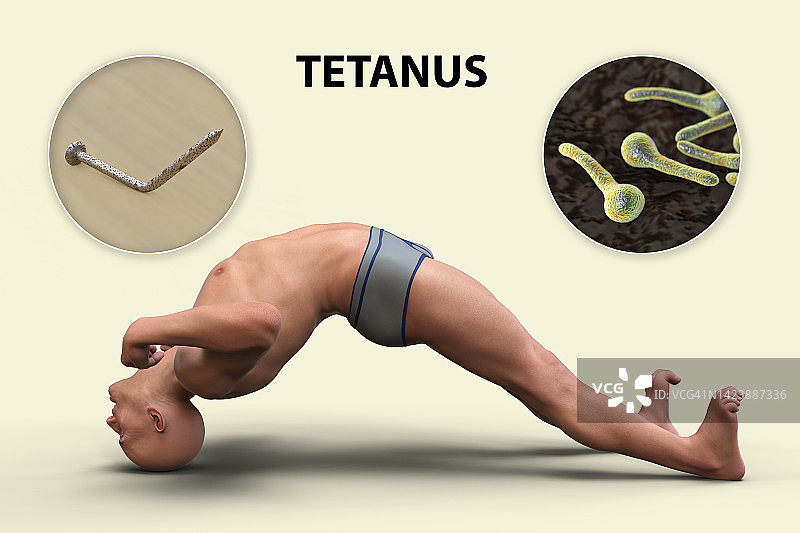 破伤风疾病的机制示意图图片素材