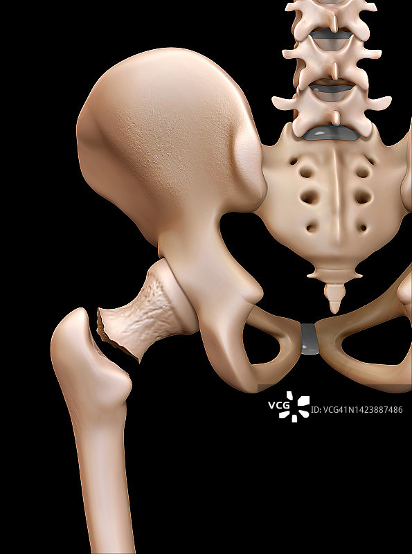 髋部骨折插图图片素材