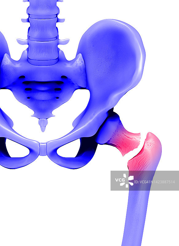 股骨骨折插图图片素材