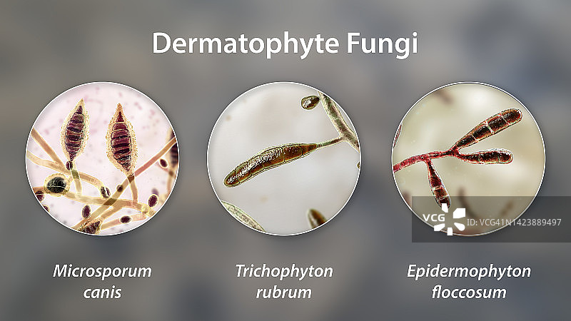 皮肤癣菌真菌，图示图片素材