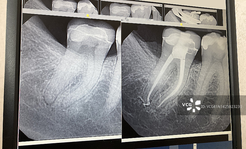 牙髓病医生诊所的根管牙科手术的数字牙科X光片图片素材