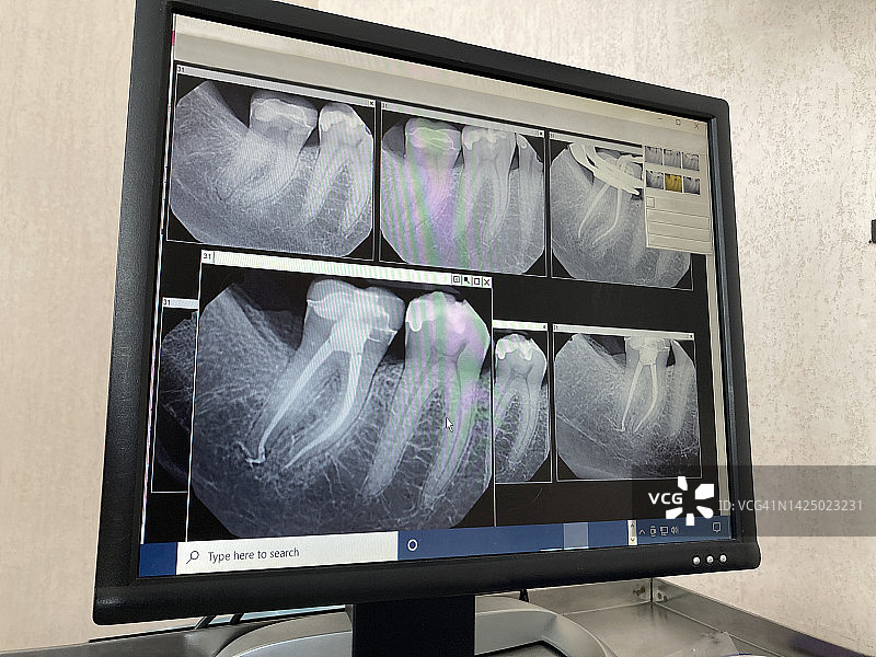 牙髓病医生诊所的根管牙科手术的数字牙科X光片图片素材
