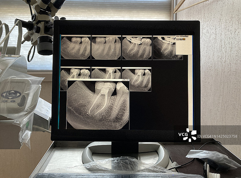 牙髓病医生诊所的根管牙科手术的数字牙科X光片图片素材
