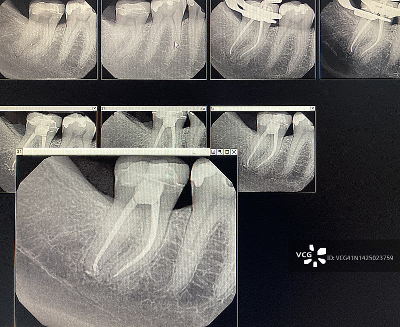 牙髓病医生诊所的根管牙科手术的数字牙科X光片图片素材