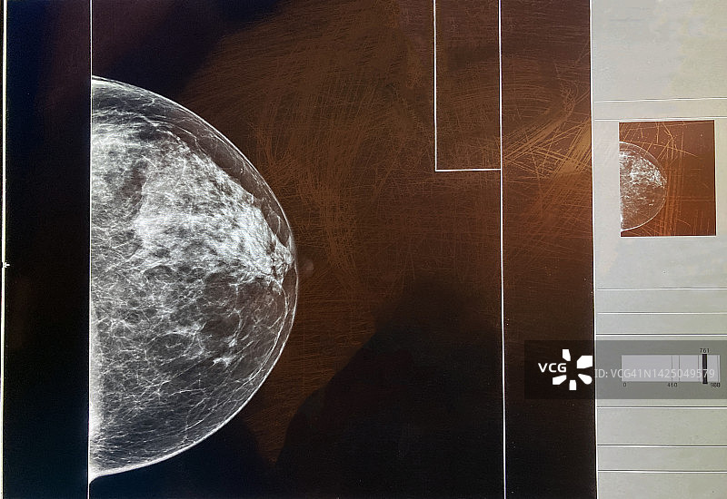 女性乳房X光片检查影像图片素材