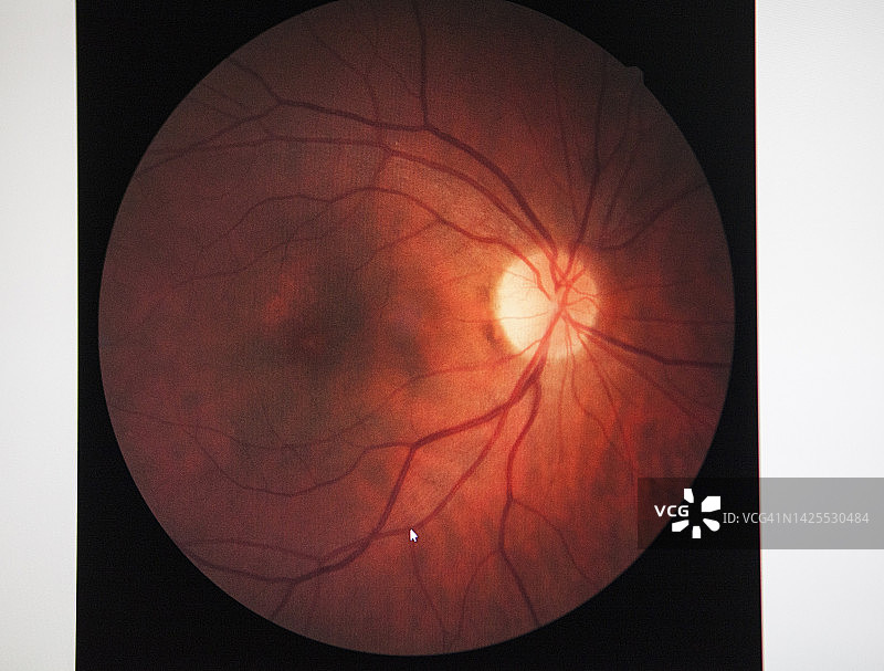 视网膜水肿图片素材