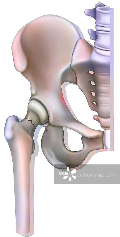 髋部骨折图图片素材