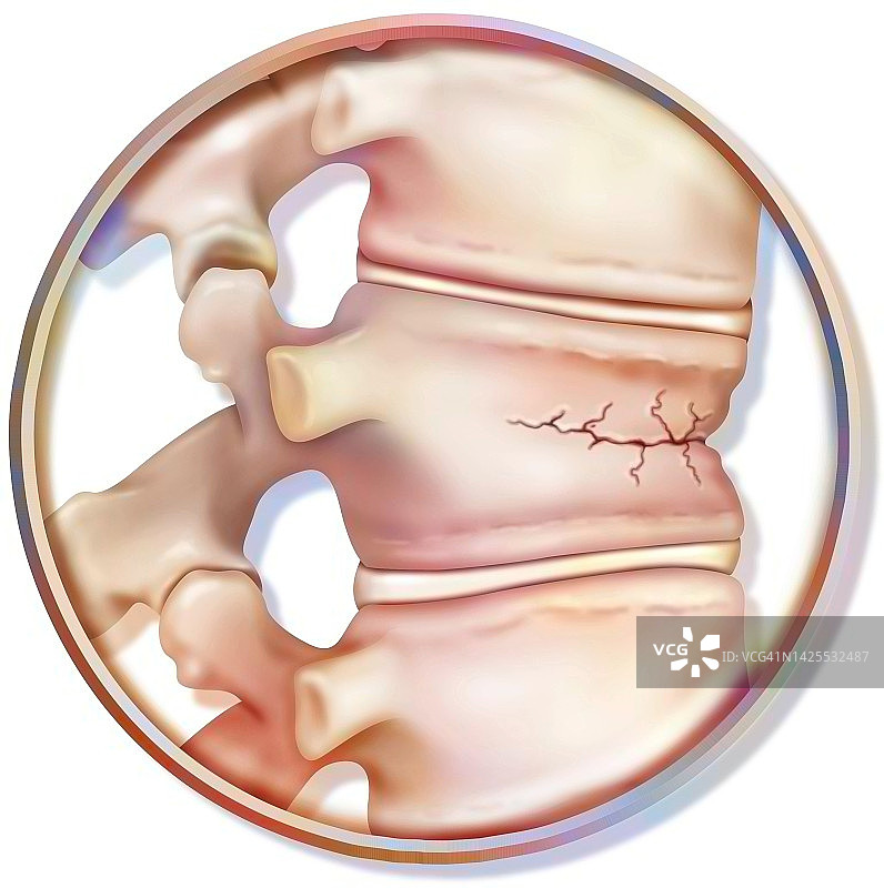 脊椎压缩图图片素材