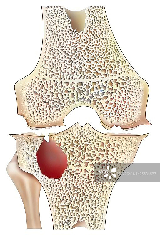 血友病性关节病图片素材