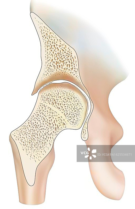 血友病性关节病图片素材