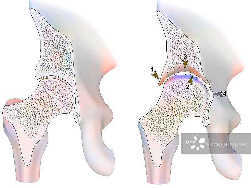 血友病性关节病图片素材