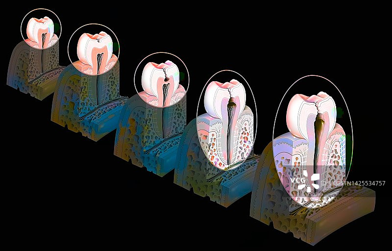 蛀牙绘画图片素材