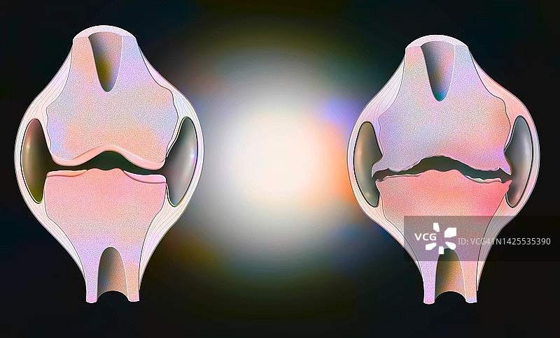 膝关节骨关节炎示意图图片素材