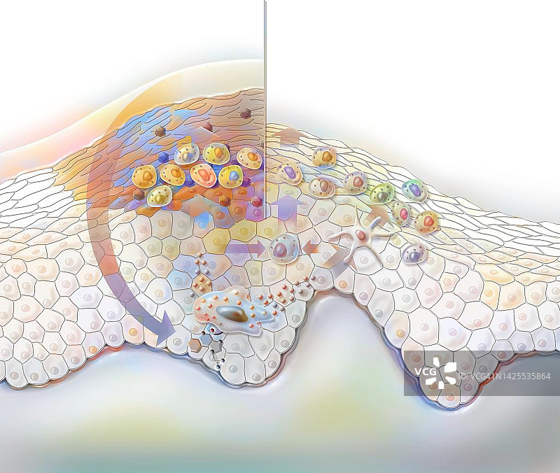疣的治疗图片素材