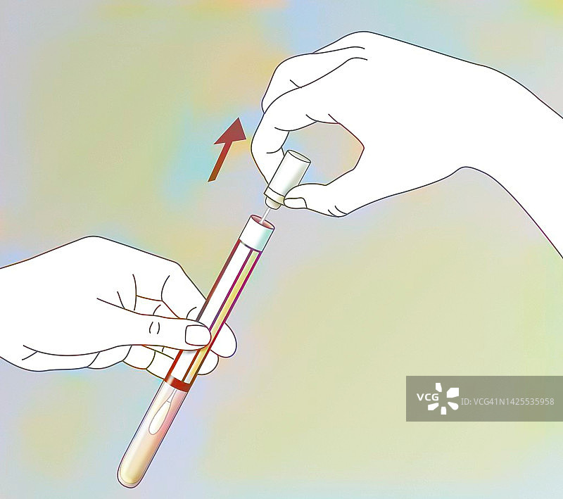 阴道取样图片素材