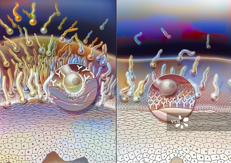 泌尿生殖系统念珠菌病图图片素材