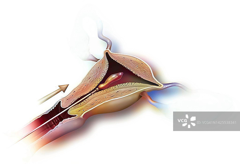 子宫内膜热凝图片素材