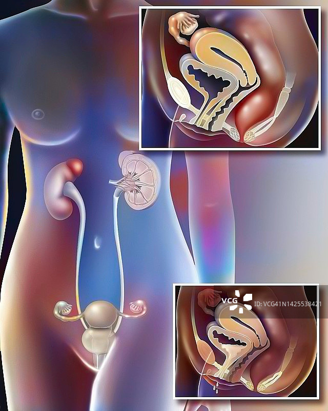 妇女尿失禁图片素材