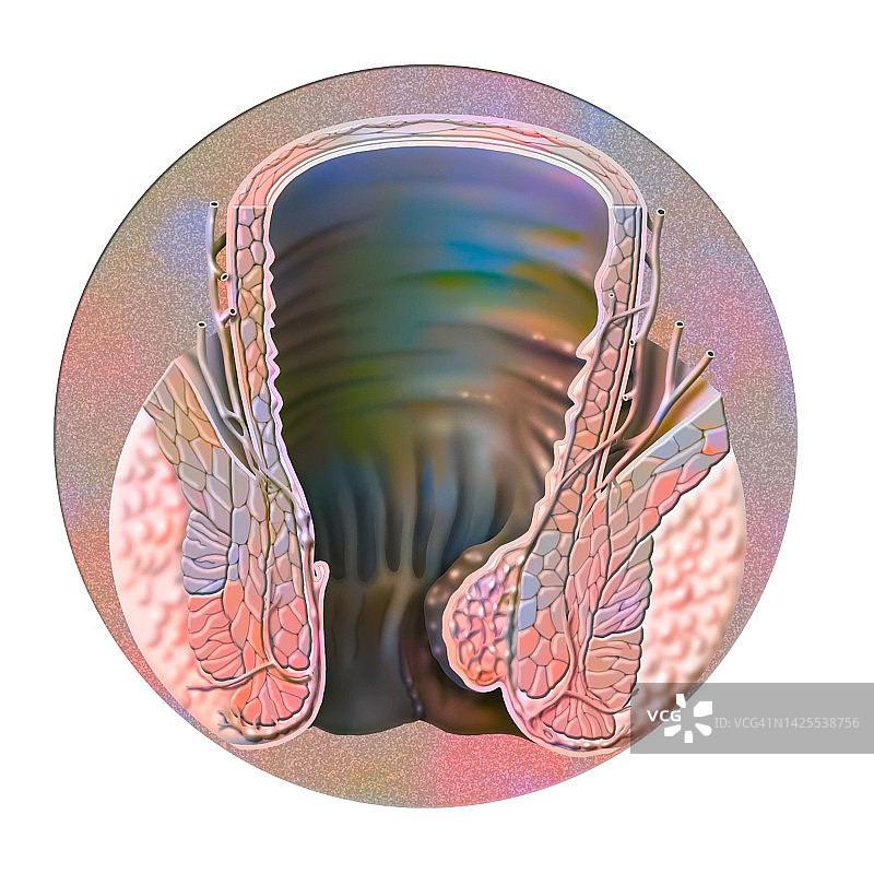 痔疮图图片素材