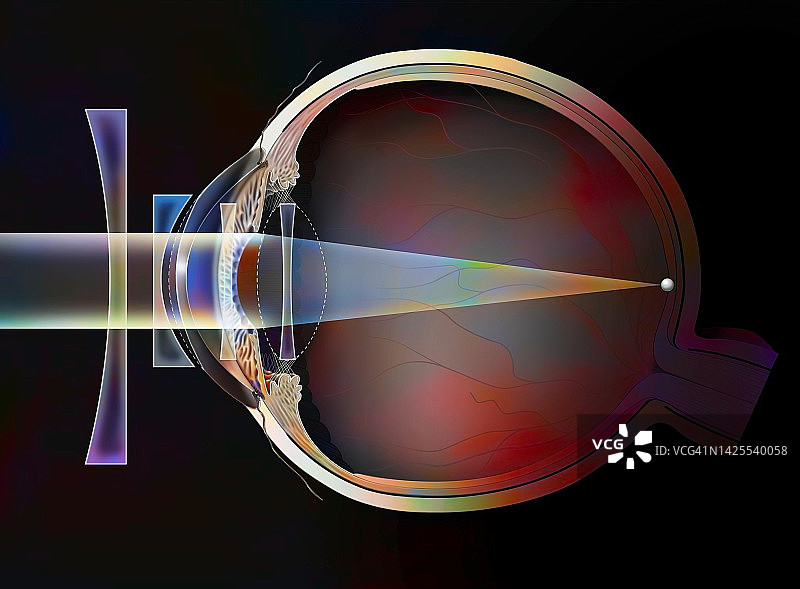 近视治疗图图片素材
