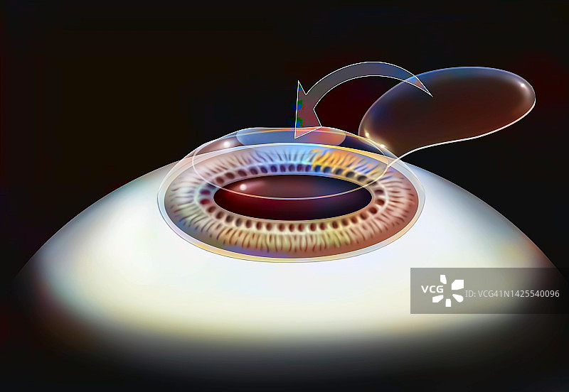 激光原位角膜磨镶术图片素材