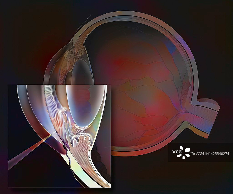 青光眼手术图图片素材