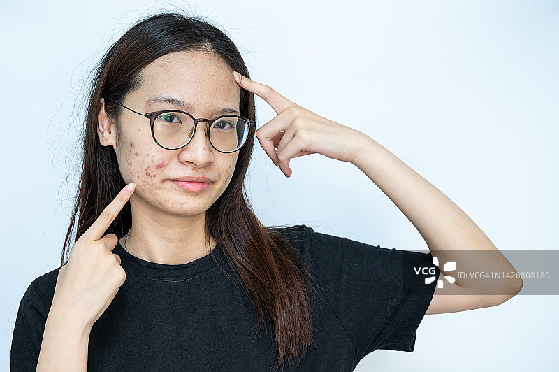 年轻的亚洲女性指着脸上发炎的痤疮问题，背景已隔离。图片素材