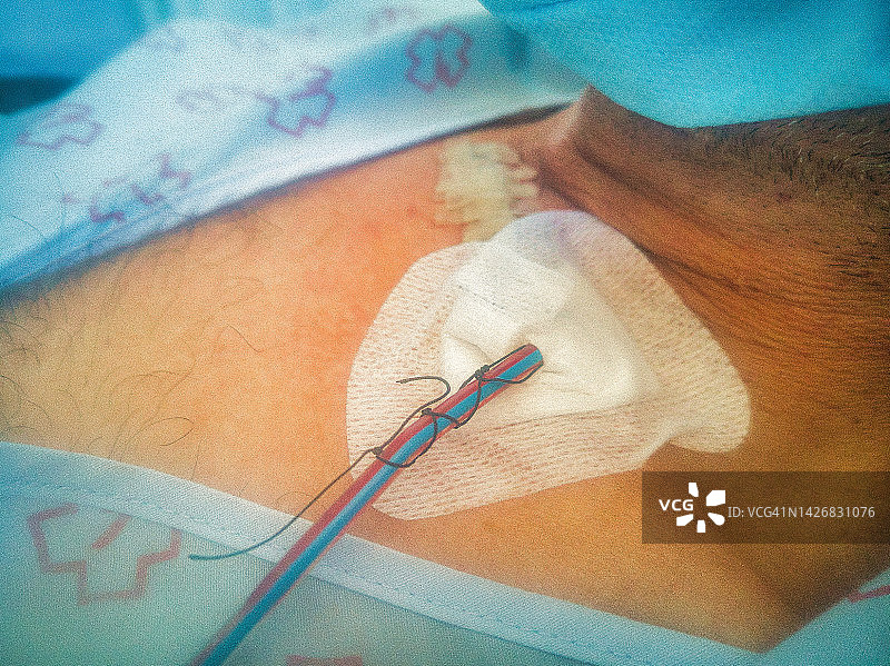 外科手术后患者使用的真空引流瓶图片素材