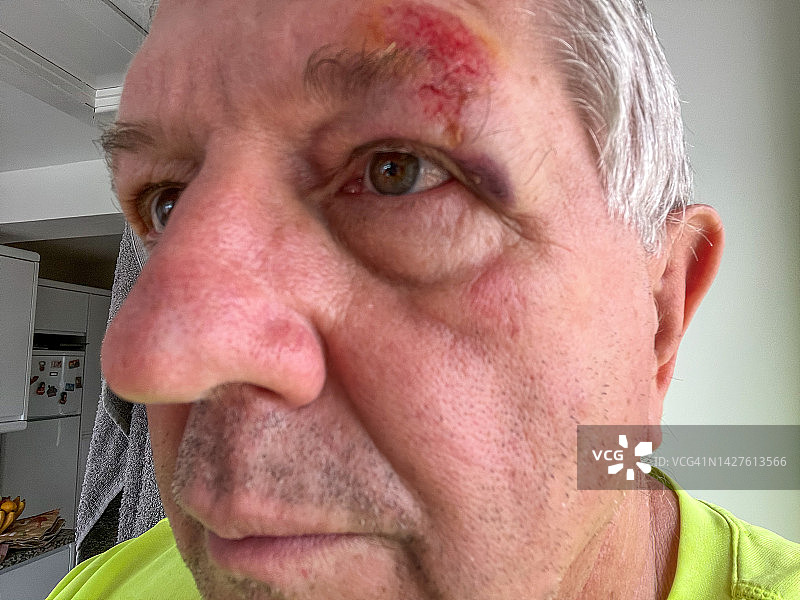 眼睛受伤的年长男子图片素材