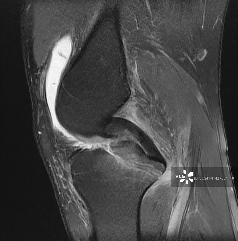 胫骨结节撕脱性骨折的胫骨平台骨折矢状位PD FatSat图像图片素材