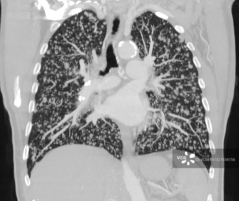 肺粟粒病：粟粒性肺病中的高分辨率CT图片素材